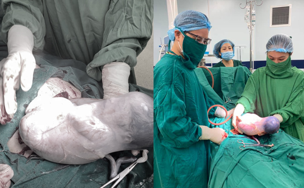 Hình ảnh bé gái vẫn còn nguyên trong bọc ối khi chào đời sáng 21/3