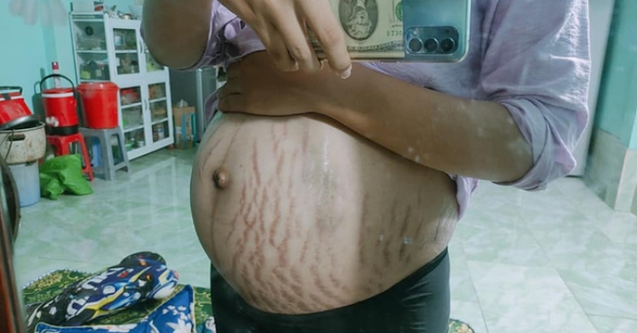 bụng bầu rạn nứt của mẹ trẻ ai nhìn cũng thương