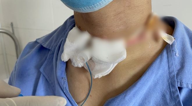 Nam bệnh nhân 19 tuổi đi xe máy không may bị dây văng công trình vướng vào cổ, chấn thương… nhưng 4 ngày sau, ho ra máu, nhập viện mới hay bị đứt lìa khí quản