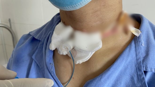 Nam bệnh nhân 19 tuổi đi xe máy không may bị dây văng công trình vướng vào cổ, chấn thương… nhưng 4 ngày sau, ho ra máu, nhập viện mới hay bị đứt lìa khí quản