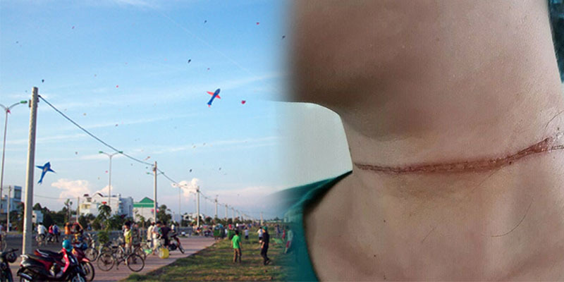 Dây diều cứa ngang gây vết thương dài trên cổ