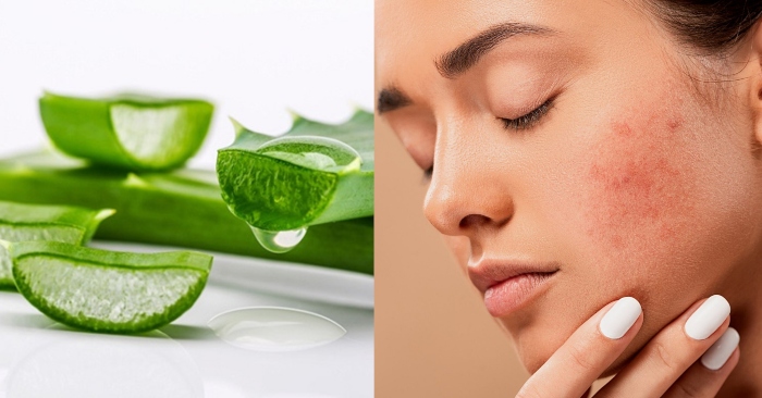 Bên cạnh công dụng làm trắng da tự nhiên, nha đam còn tác dụng trị mụn hiệu quả.. Với cách trị mụn bằng nha đam, sẽ khiến các đốm mụn khó ưa biến mất nhanh chóng và trả lại cho bạn làn da trắng hồng, mềm mịn.