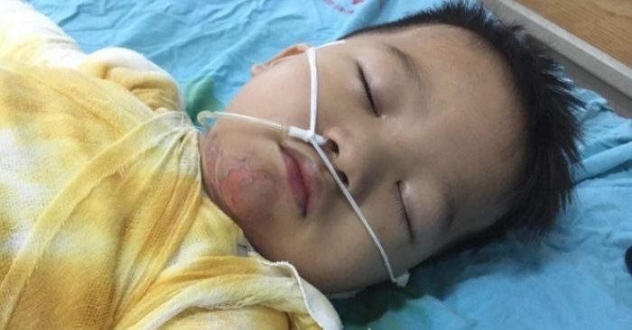 Xót xa cảnh cậu bé ngã vào nồi canh nóng, bỏng nặng nguy kịch
